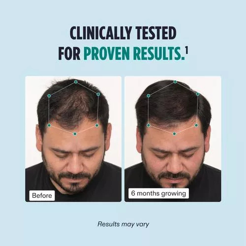Before and After Nutrafol Men regrowth formula - one of the best hair regrowth for men supplements.